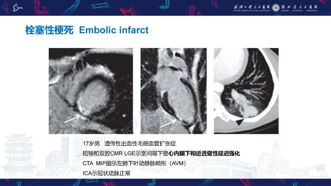 影像PPT - 【PPT】冠状动脉非阻塞性心肌梗死影像诊断-25
