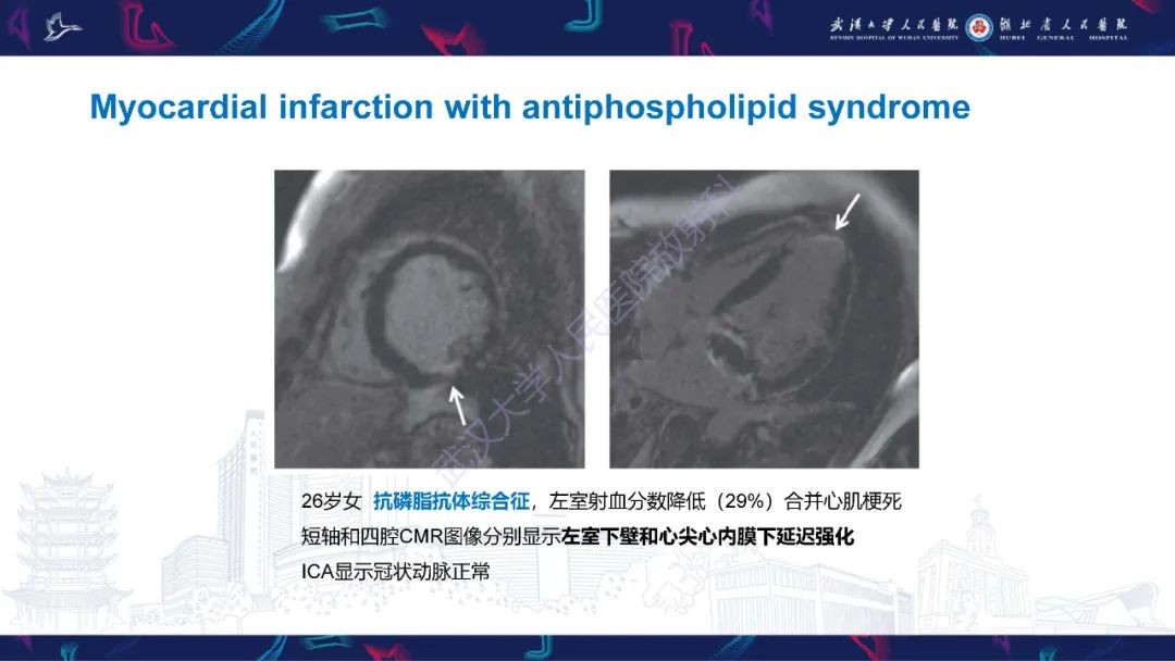 影像PPT - 【PPT】冠状动脉非阻塞性心肌梗死影像诊断-26