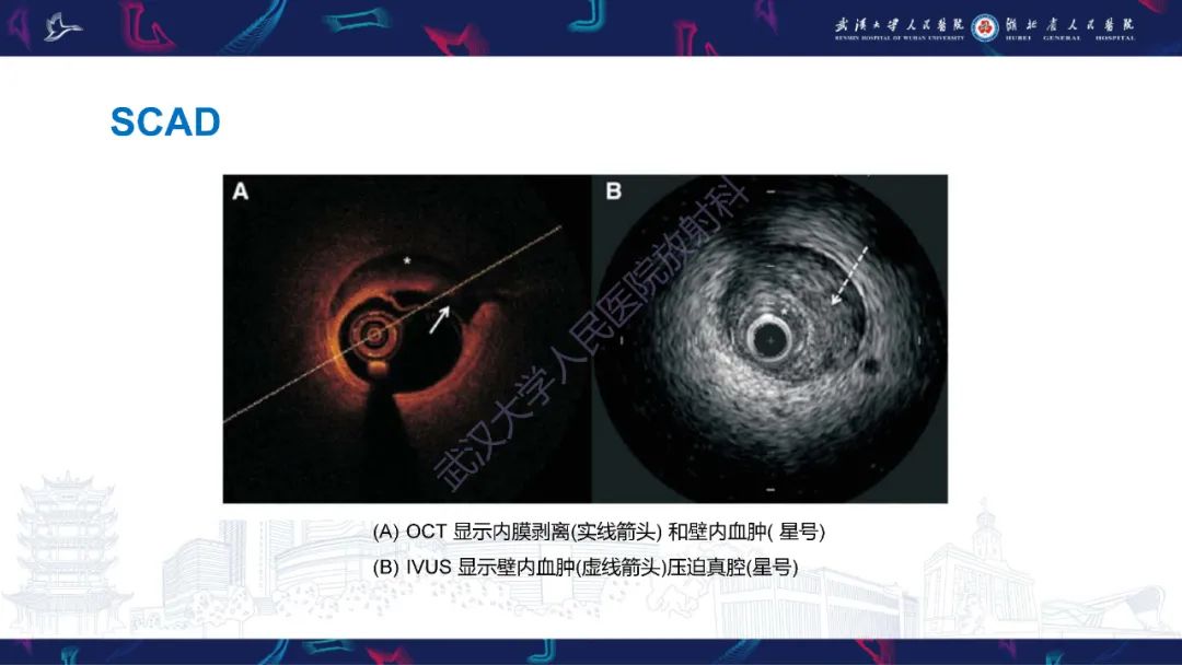 影像PPT - 【PPT】冠状动脉非阻塞性心肌梗死影像诊断-28