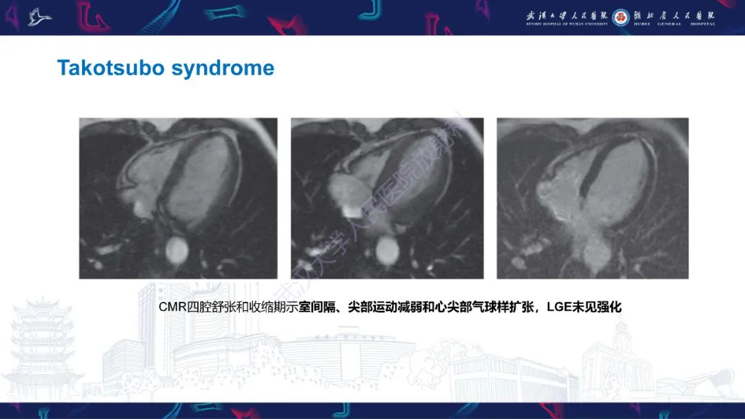 影像PPT - 【PPT】冠状动脉非阻塞性心肌梗死影像诊断-35