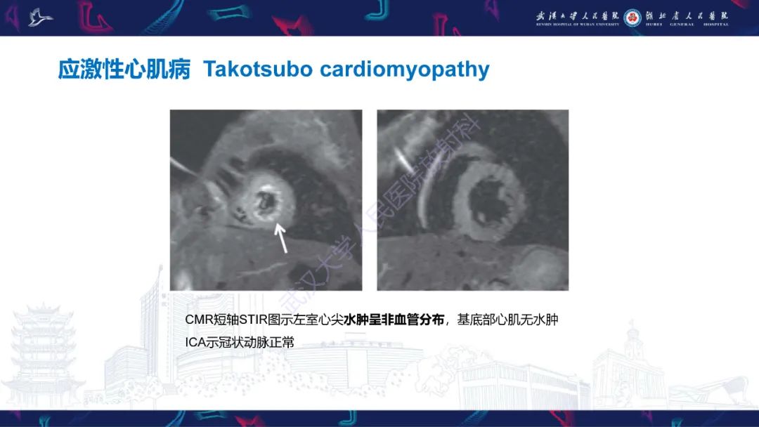 影像PPT - 【PPT】冠状动脉非阻塞性心肌梗死影像诊断-36