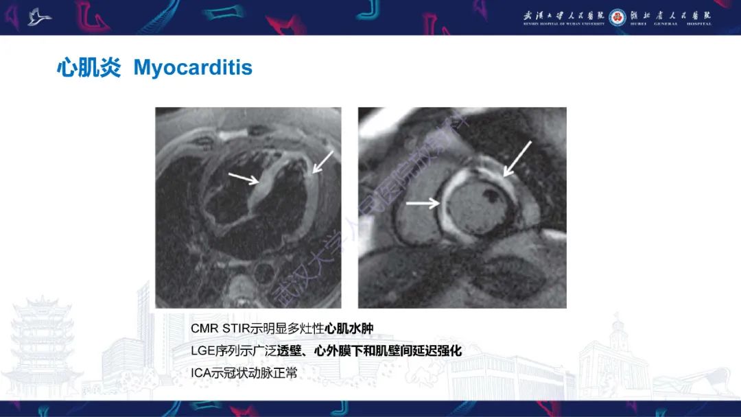影像PPT - 【PPT】冠状动脉非阻塞性心肌梗死影像诊断-38