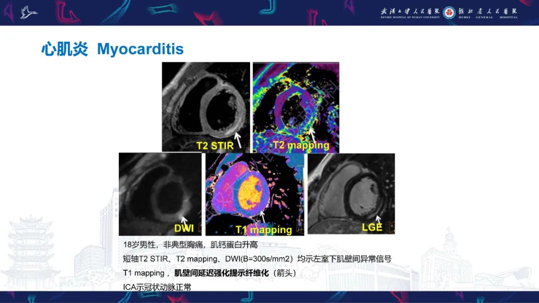 影像PPT - 【PPT】冠状动脉非阻塞性心肌梗死影像诊断-40