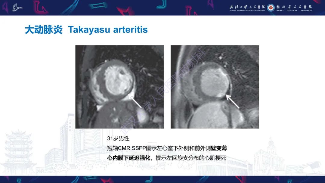 影像PPT - 【PPT】冠状动脉非阻塞性心肌梗死影像诊断-42