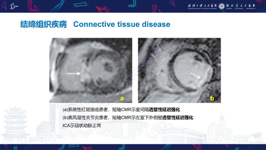 影像PPT - 【PPT】冠状动脉非阻塞性心肌梗死影像诊断-44