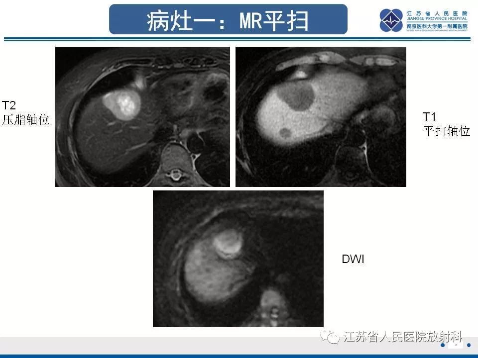 影像PPT - 【PPT】肝上皮样血管内皮瘤-3