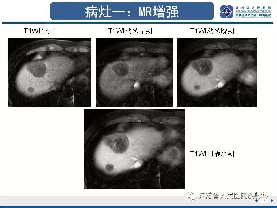 影像PPT - 【PPT】肝上皮样血管内皮瘤-4