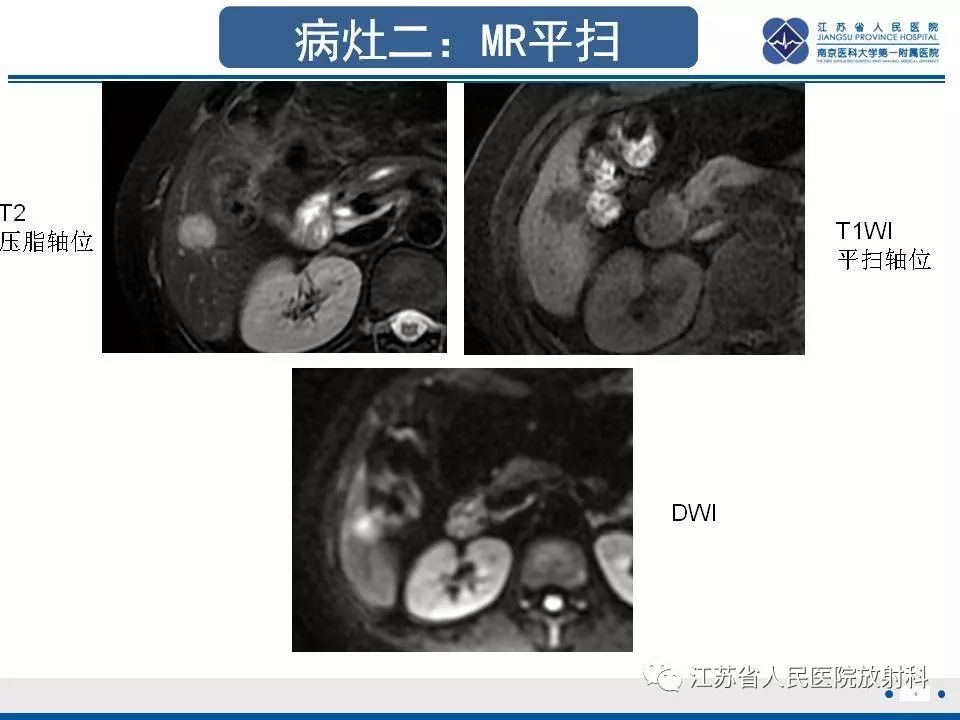 影像PPT - 【PPT】肝上皮样血管内皮瘤-5
