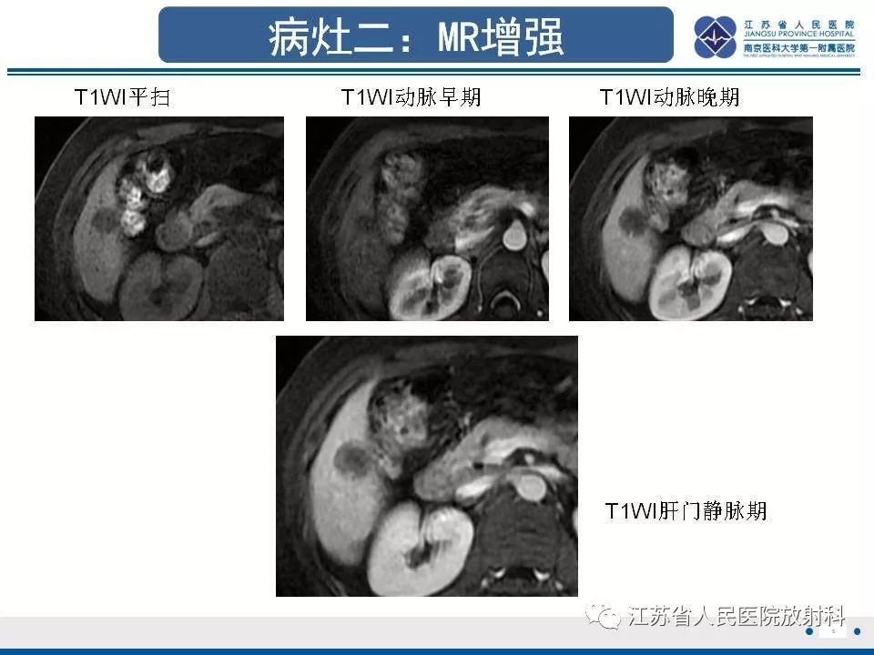 影像PPT - 【PPT】肝上皮样血管内皮瘤-6