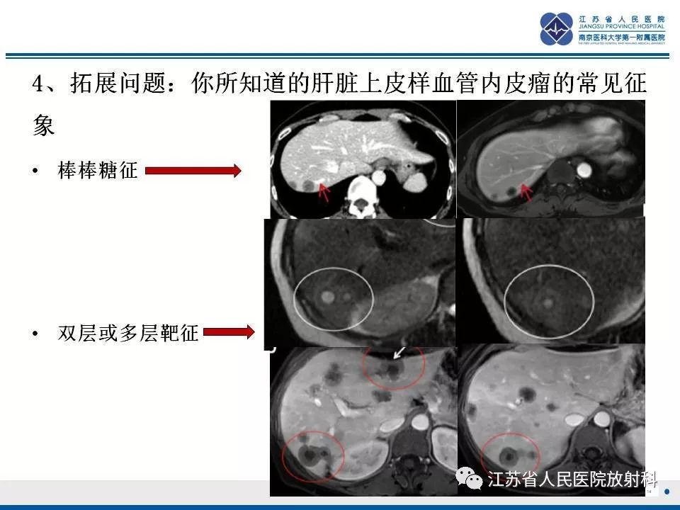 影像PPT - 【PPT】肝上皮样血管内皮瘤-15