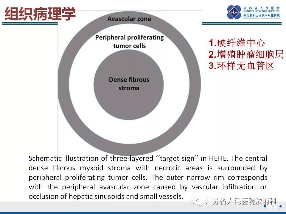 影像PPT - 【PPT】肝上皮样血管内皮瘤-18