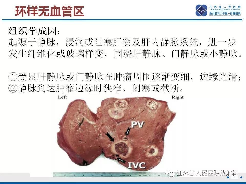 影像PPT - 【PPT】肝上皮样血管内皮瘤-19