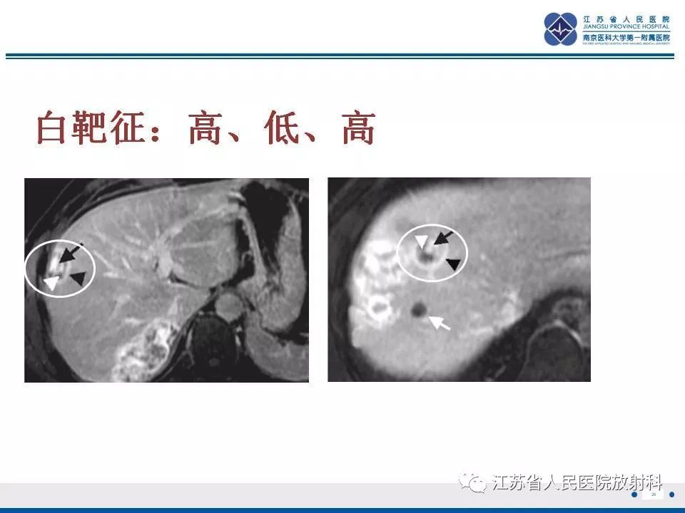 影像PPT - 【PPT】肝上皮样血管内皮瘤-27