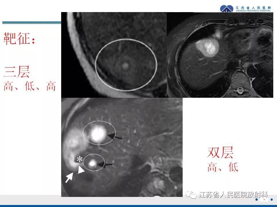 影像PPT - 【PPT】肝上皮样血管内皮瘤-23