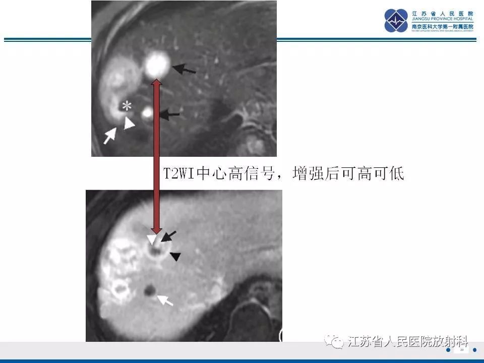 影像PPT - 【PPT】肝上皮样血管内皮瘤-30