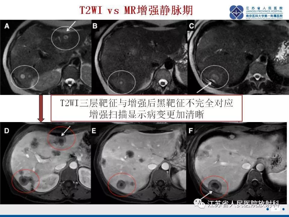影像PPT - 【PPT】肝上皮样血管内皮瘤-29
