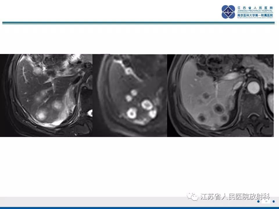 影像PPT - 【PPT】肝上皮样血管内皮瘤-36