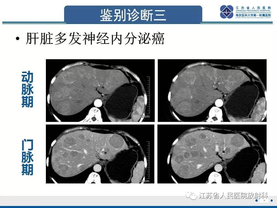 影像PPT - 【PPT】肝上皮样血管内皮瘤-39