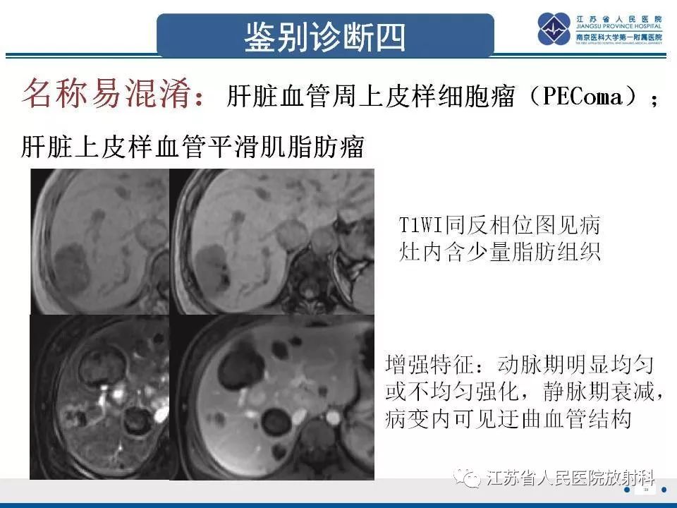 影像PPT - 【PPT】肝上皮样血管内皮瘤-40
