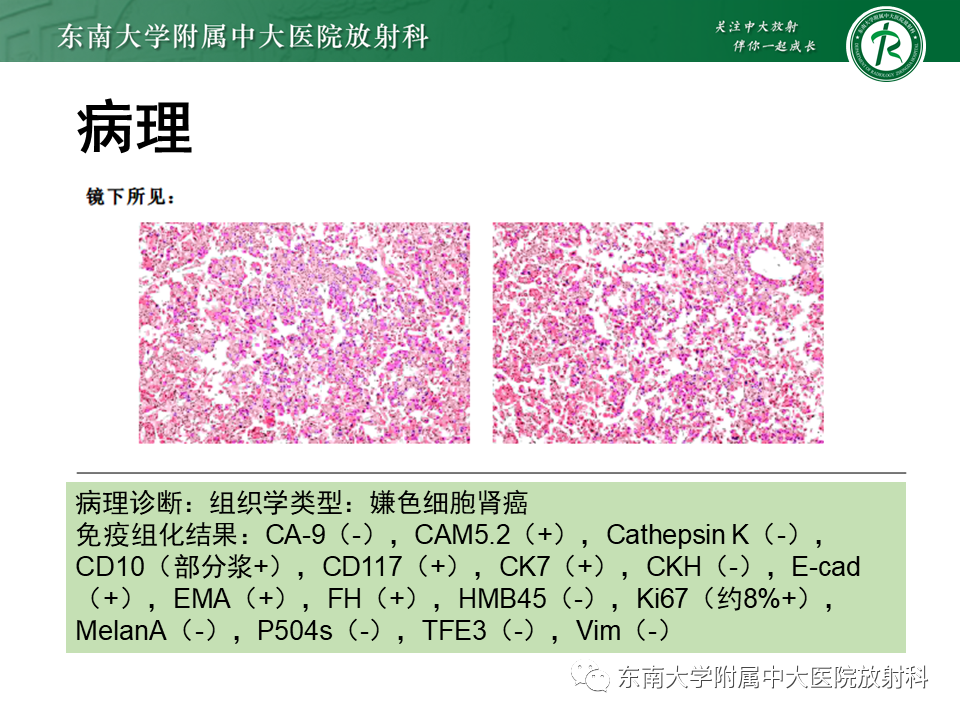 影像PPT - 【PPT】肾嫌色细胞癌-4