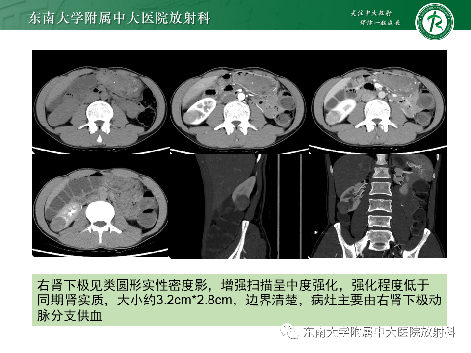 影像PPT - 【PPT】肾嫌色细胞癌-3