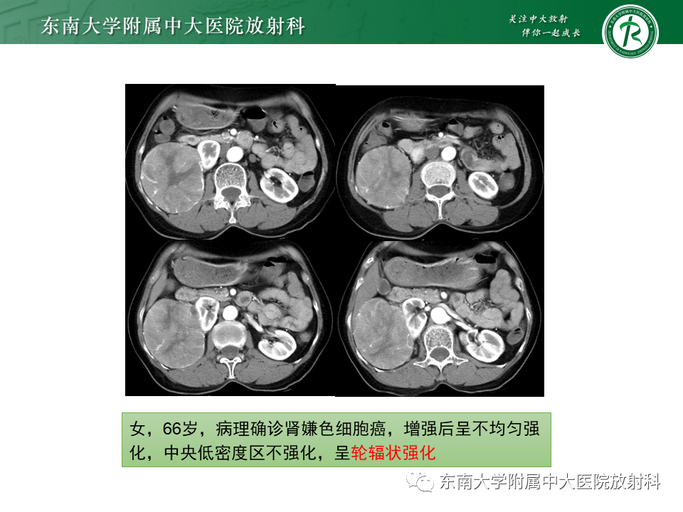 影像PPT - 【PPT】肾嫌色细胞癌-8