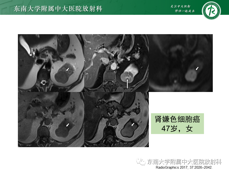 影像PPT - 【PPT】肾嫌色细胞癌-9