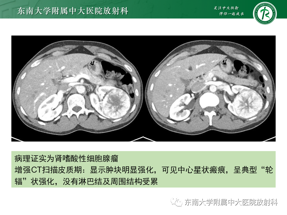 影像PPT - 【PPT】肾嫌色细胞癌-13