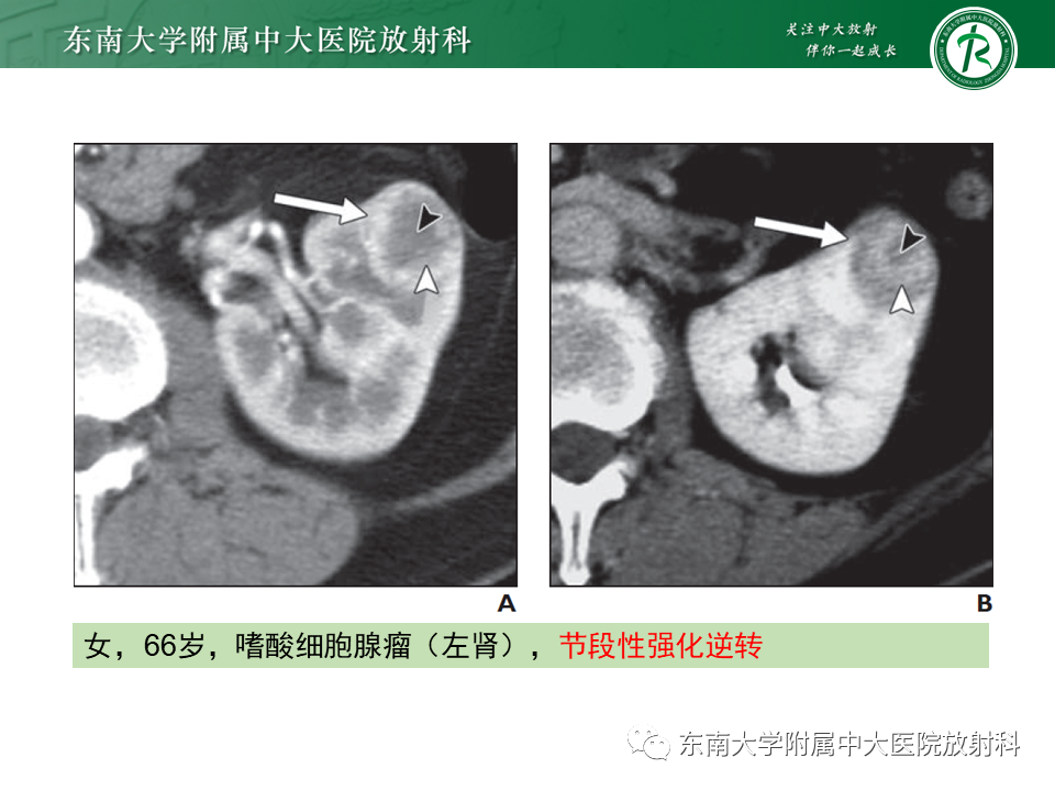 影像PPT - 【PPT】肾嫌色细胞癌-14