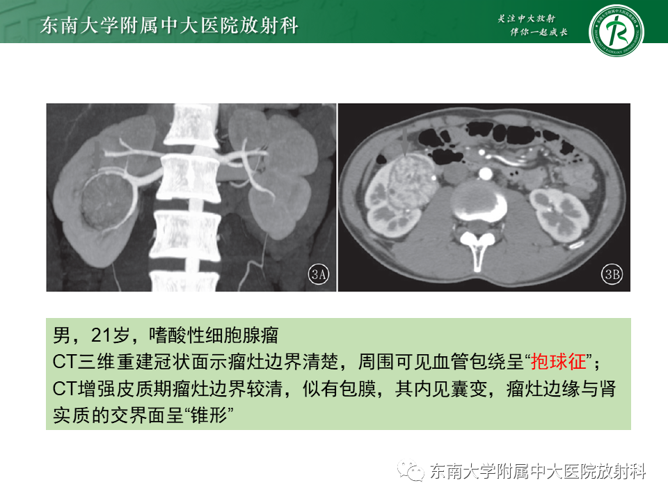 影像PPT - 【PPT】肾嫌色细胞癌-15
