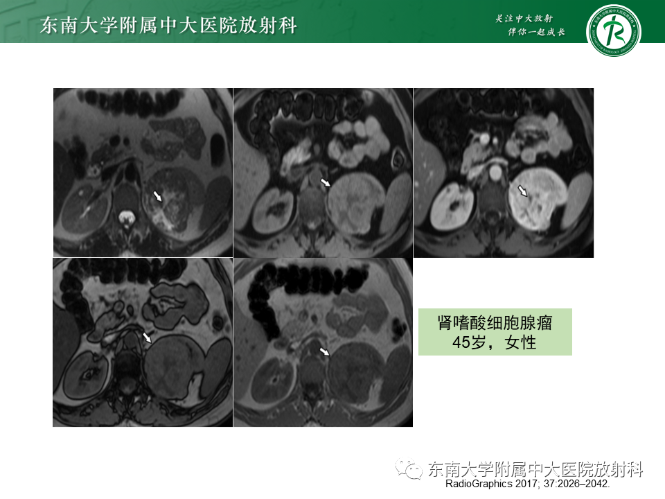 影像PPT - 【PPT】肾嫌色细胞癌-16