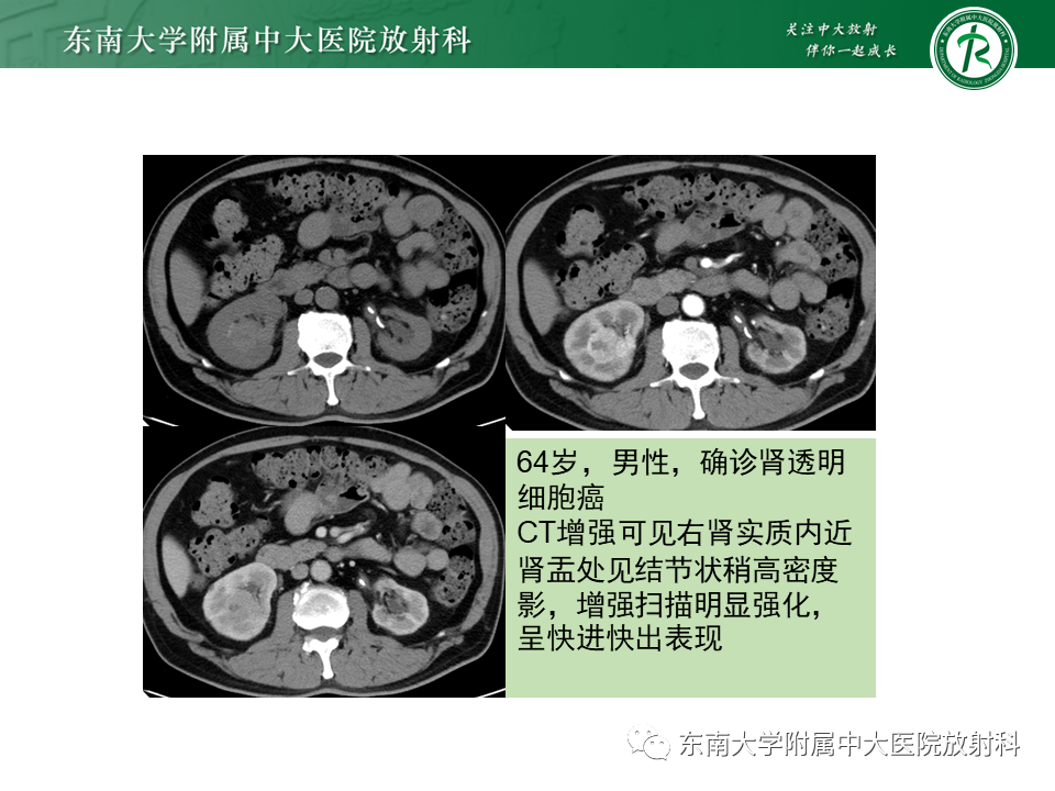 影像PPT - 【PPT】肾嫌色细胞癌-19