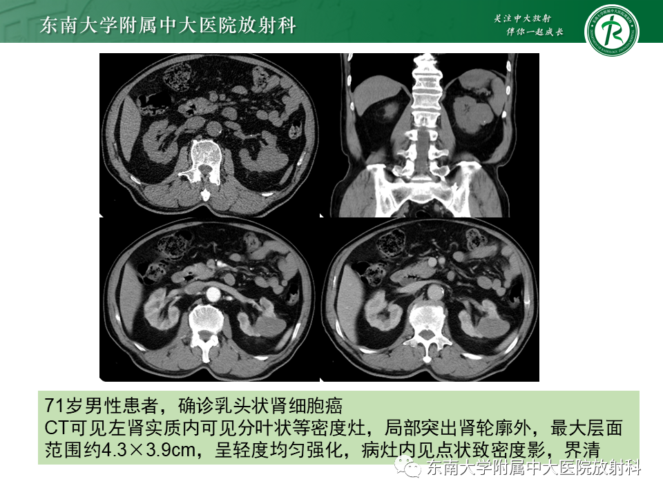 影像PPT - 【PPT】肾嫌色细胞癌-22