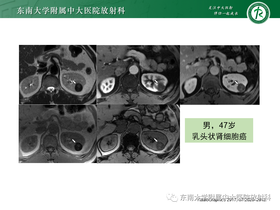 影像PPT - 【PPT】肾嫌色细胞癌-23