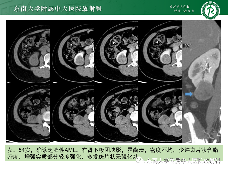 影像PPT - 【PPT】肾嫌色细胞癌-26