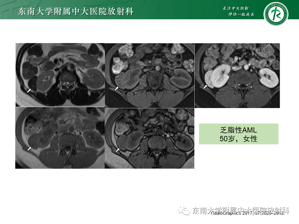 影像PPT - 【PPT】肾嫌色细胞癌-27