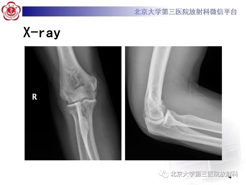 影像PPT - 【PPT】肘管综合征-3