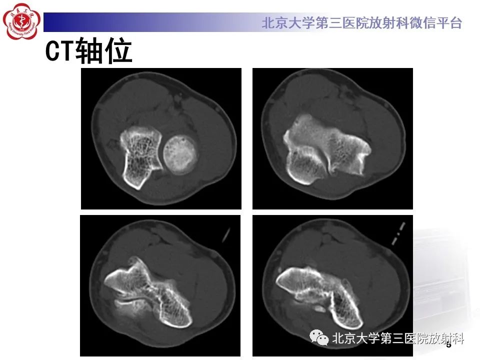 影像PPT - 【PPT】肘管综合征-4