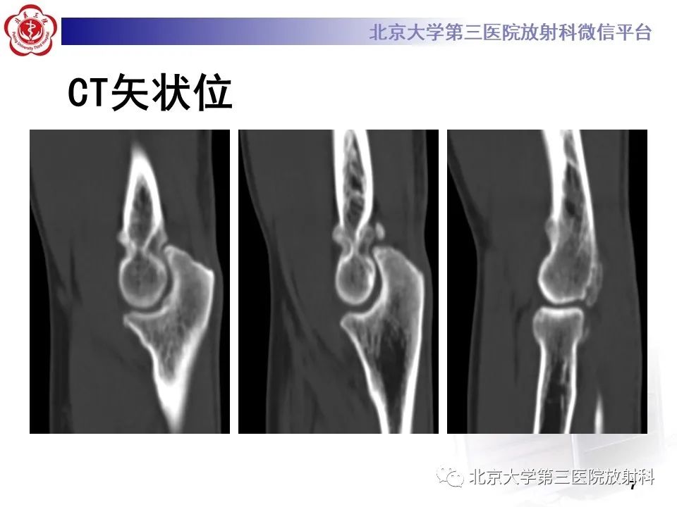 影像PPT - 【PPT】肘管综合征-6