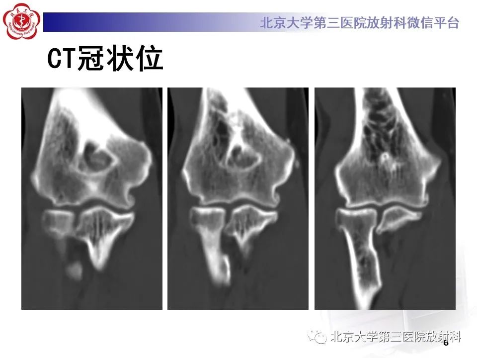影像PPT - 【PPT】肘管综合征-5