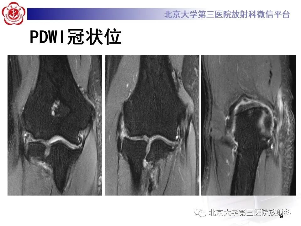 影像PPT - 【PPT】肘管综合征-8