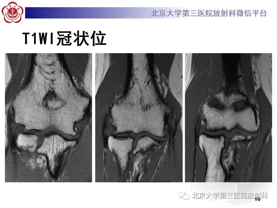 影像PPT - 【PPT】肘管综合征-9
