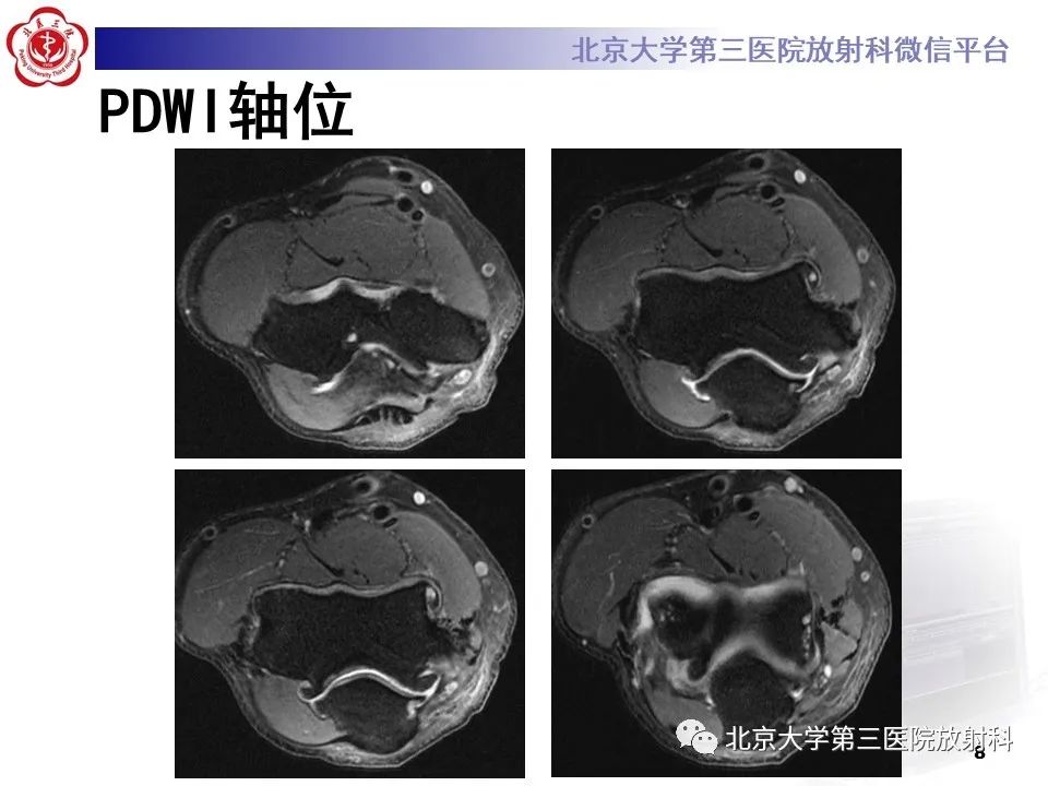 影像PPT - 【PPT】肘管综合征-7