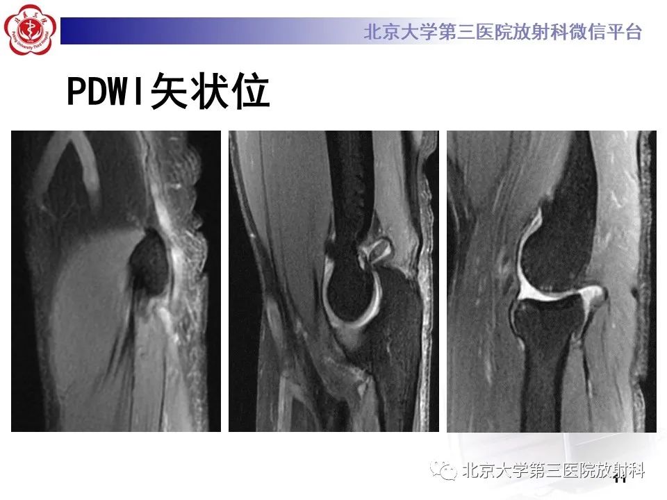 影像PPT - 【PPT】肘管综合征-10