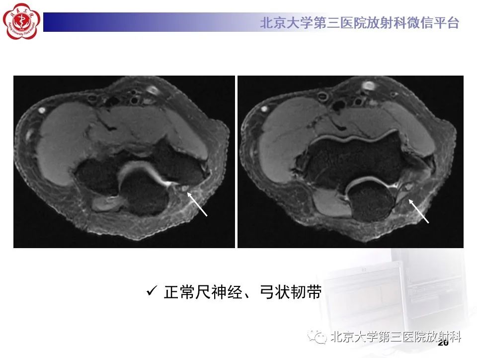 影像PPT - 【PPT】肘管综合征-19