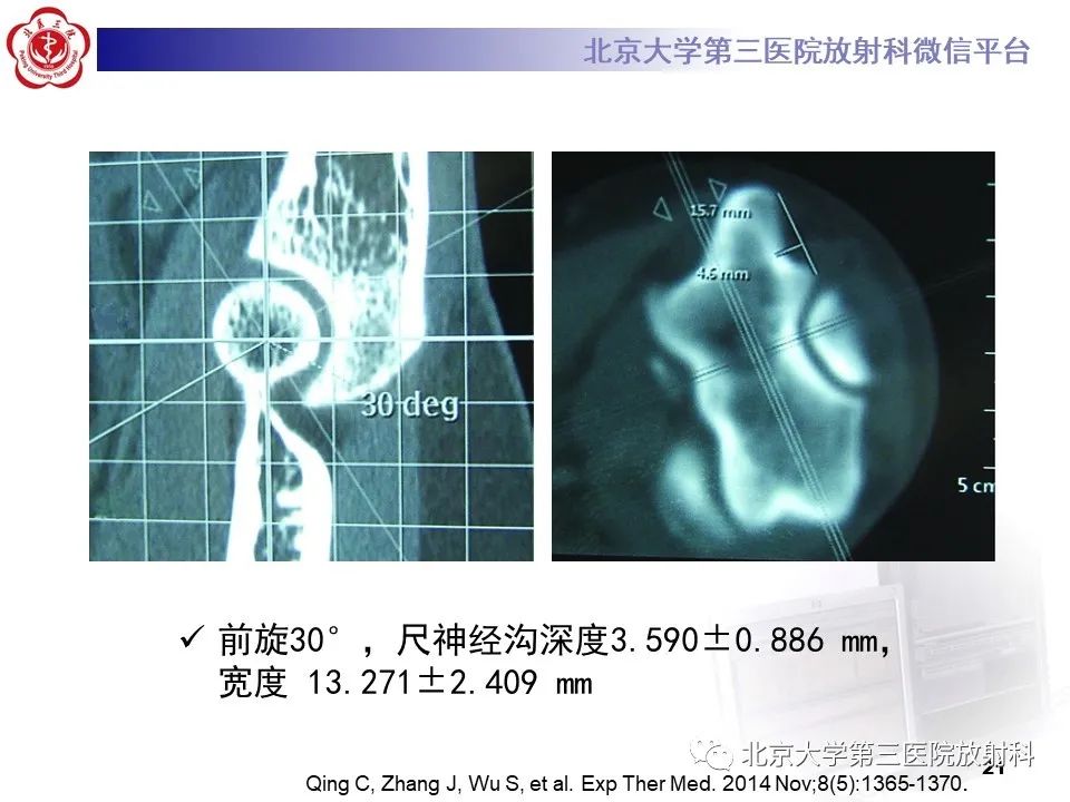 影像PPT - 【PPT】肘管综合征-20