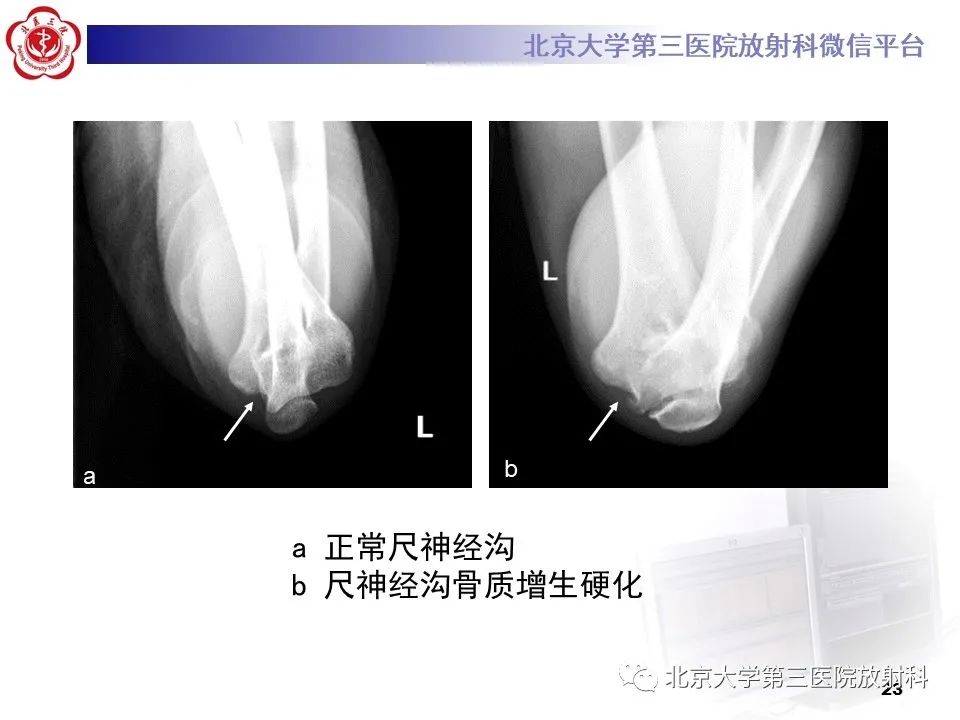 影像PPT - 【PPT】肘管综合征-22