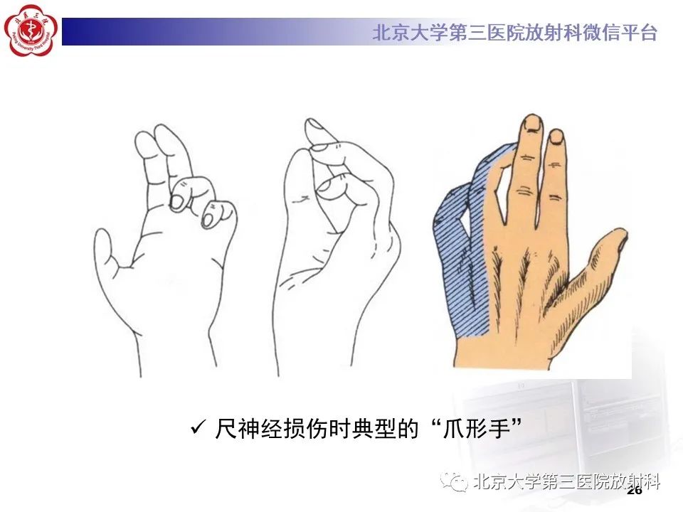 影像PPT - 【PPT】肘管综合征-25