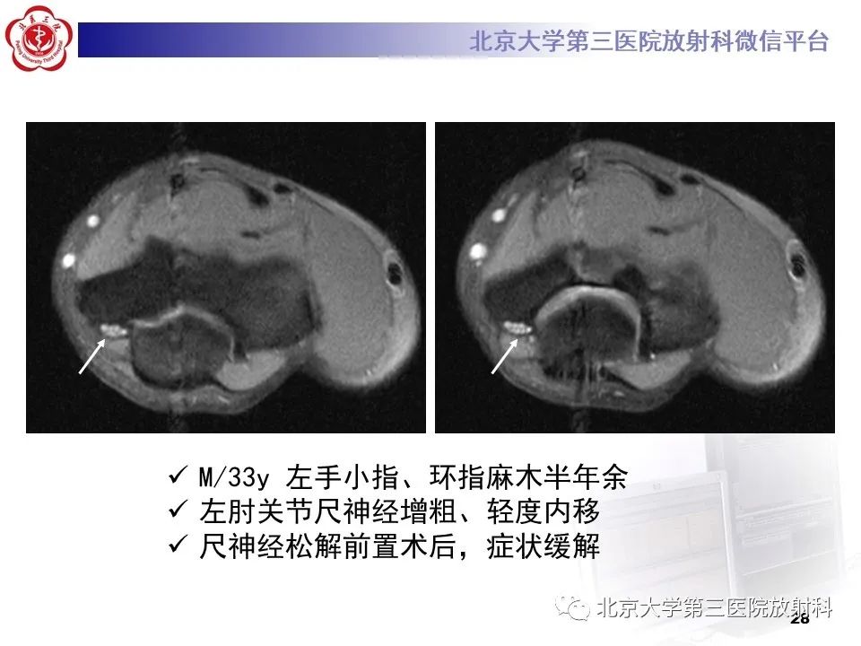 影像PPT - 【PPT】肘管综合征-27