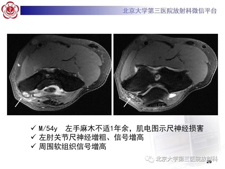 影像PPT - 【PPT】肘管综合征-28